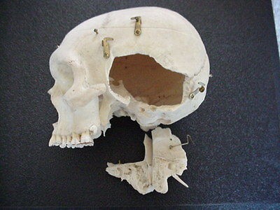 GENUINE ARTICULATED DISSECTED HUMAN SKULL FOR MEDICAL STUDY