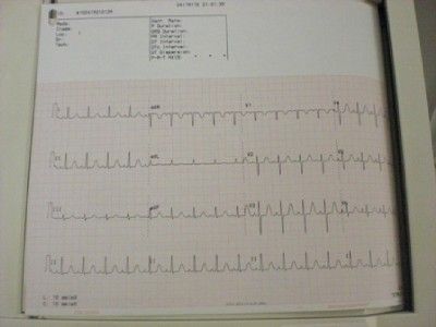 burdick eclipse le ii non interpretive ekg $ 1400